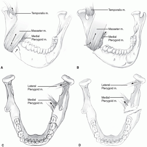 Types Of Mandibular Fractures